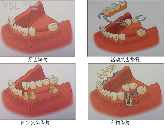 鑲牙疼嗎需要多長時(shí)間