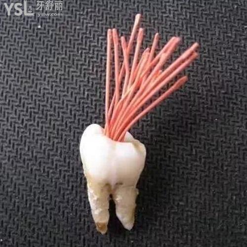 牙疼根管治療是什么意思？