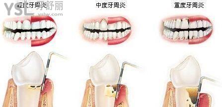細數(shù)中年人牙齒容易爛是什么原因5