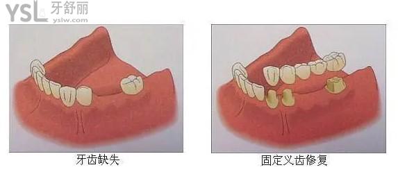 固定假牙