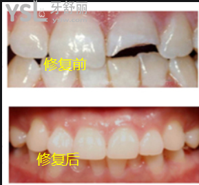 牙齒被打斷怎么修復(fù)