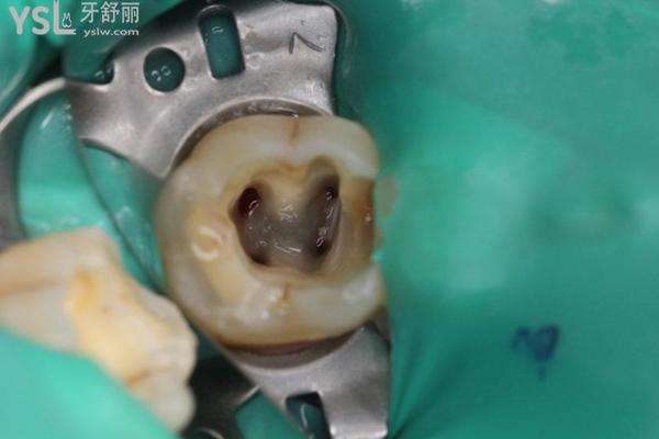 牙齒根管治療一直流血是什么原因？