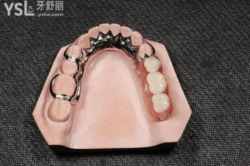 成人牙掉了可以做活動義齒
