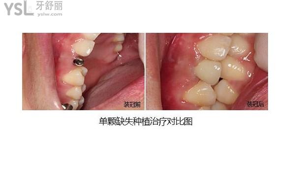 種植牙修復(fù)牙齒缺失圖片