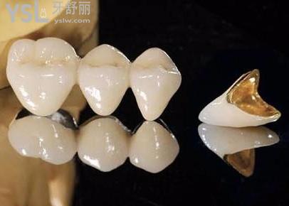 缺一顆牙齒怎么補(bǔ)好2