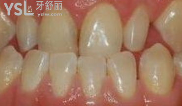 對刃頜的危害是什么，對刃頜矯正需要多少錢有必要嗎