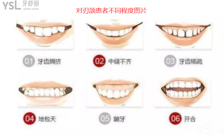 對刃頜的危害是什么，對刃頜矯正需要多少錢有必要嗎