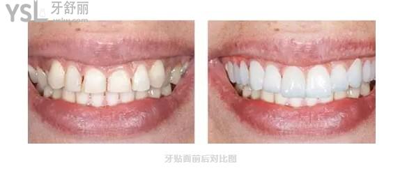 牙貼面對(duì)比圖