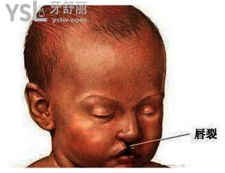 兔唇是顯性遺傳還是隱性遺傳，完全修復(fù)要多少錢.jpg