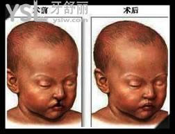 兔唇是顯性遺傳還是隱性遺傳，完全修復(fù)要多少錢.jpg