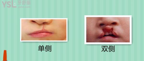 兔唇可以完全無(wú)痕跡的修復(fù)嗎，多少錢在幾歲做好