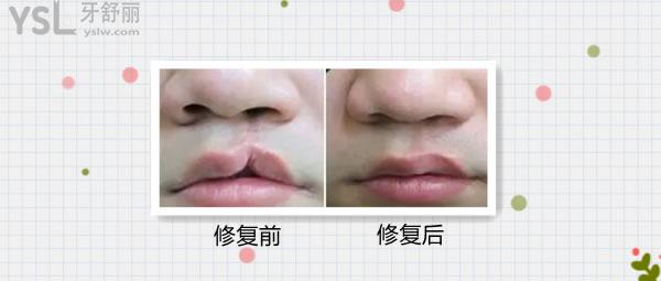 兔唇可以完全無(wú)痕跡的修復(fù)嗎，多少錢在幾歲做好