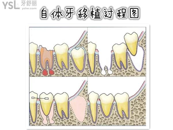 自體牙移植術(shù)過程圖