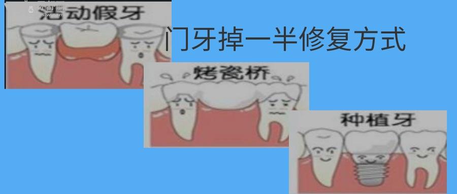 門牙掉一半修復多少錢
