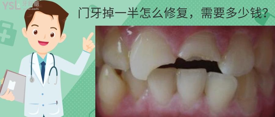 門牙掉一半修復多少錢