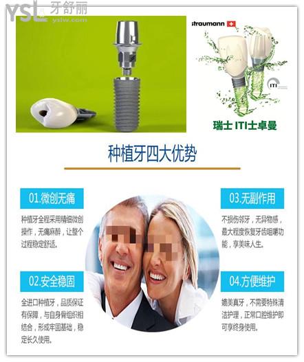 2021年瑞典諾貝爾種植牙全系列價格表 與瑞士ITI.jpg