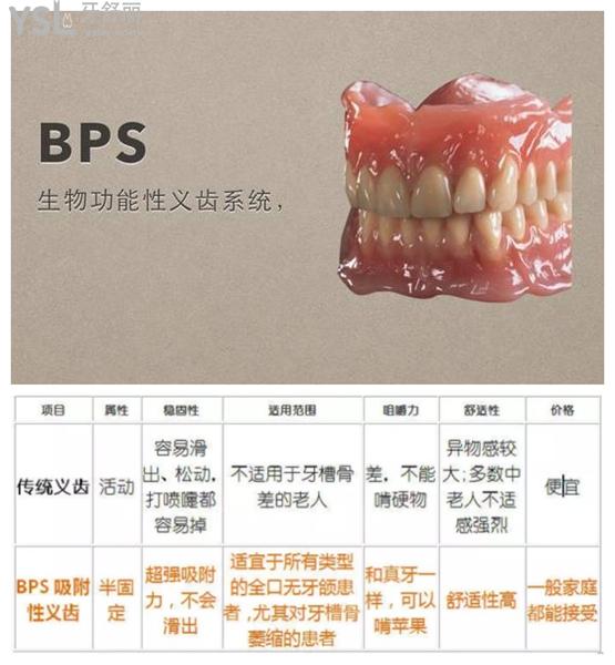 BPS吸附性義齒優(yōu)勢(shì)