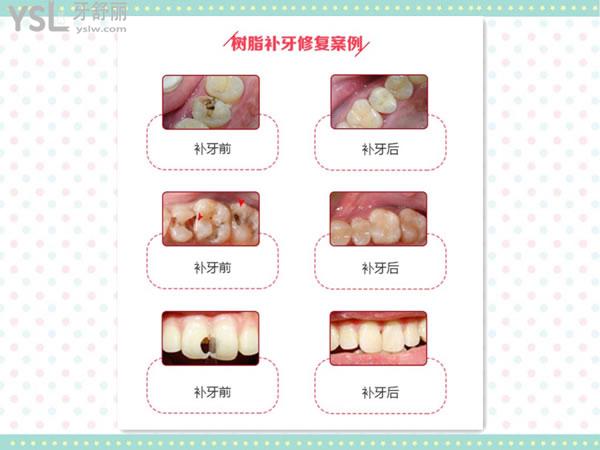 樹(shù)脂補(bǔ)牙對(duì)比圖