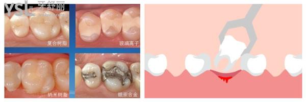 補牙和拔牙圖片