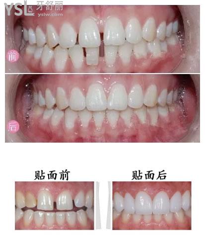 牙貼面改善牙縫對(duì)比圖