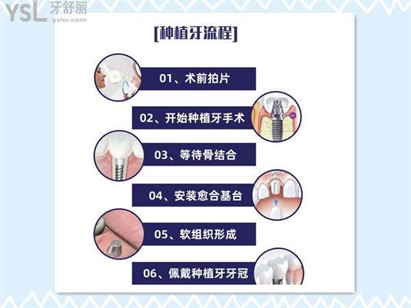 種植牙流程圖