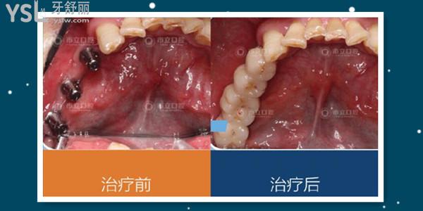 南寧市立口腔門診收費(fèi)標(biāo)準(zhǔn)更新 親診患者說(shuō) 醫(yī)生技術(shù)好價(jià)格便宜還能刷**.jpg