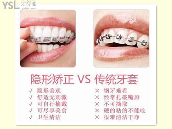 隱形矯正對(duì)比傳統(tǒng)牙套的優(yōu)勢(shì)