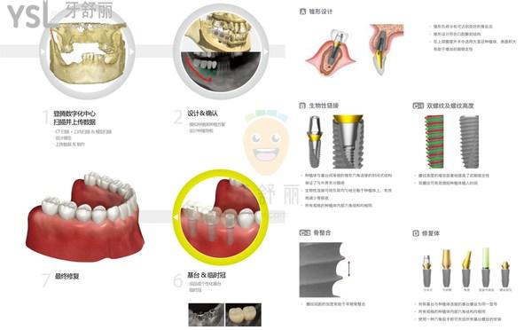 韓國登騰二代是幾年產(chǎn)出的，韓國登騰二代種植牙壽命是多少年