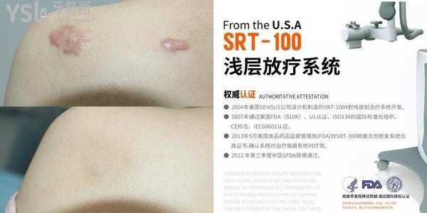 SRT100放療祛疤痕的費(fèi)用以及復(fù)發(fā)率怎么樣？