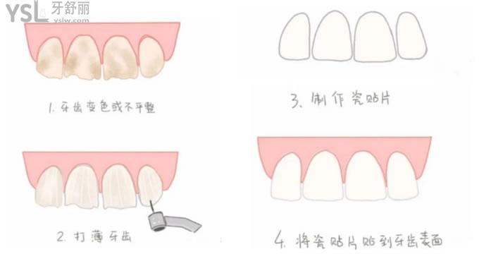 牙齒貼面制作過(guò)程