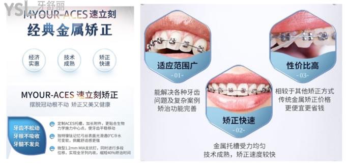 重慶美奧口腔金屬矯正優(yōu)勢(shì)
