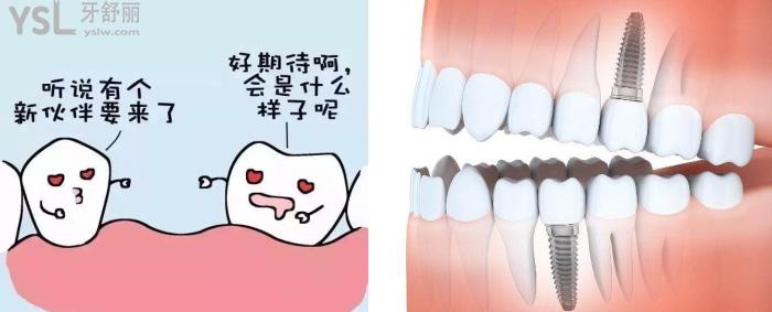 在醫(yī)院一般種植一顆牙要花多少錢，人工種植牙能用多久？.jpg