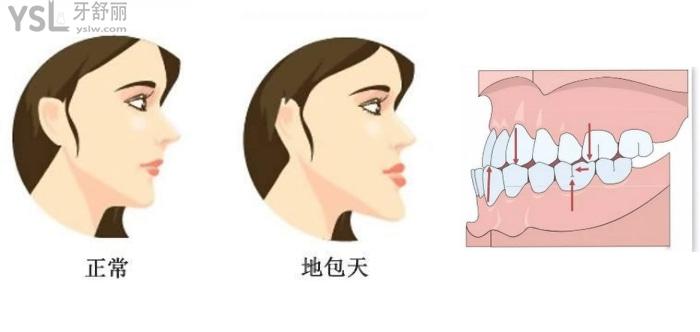 地包天正畸
