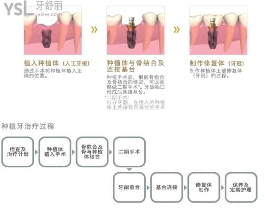 奧齒泰種植牙和登騰種植牙哪個好.jpg