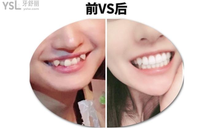成人盡量不要矯正牙齒？究竟是有風(fēng)險(xiǎn)還是怕你<span style=