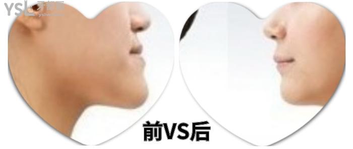 成人盡量不要矯正牙齒？究竟是有風(fēng)險(xiǎn)還是怕你<span style=