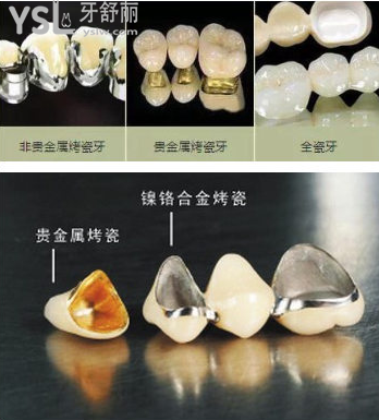 烤瓷牙和全瓷牙的價格表