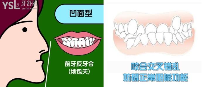 地包天不矯正會(huì)怎么樣