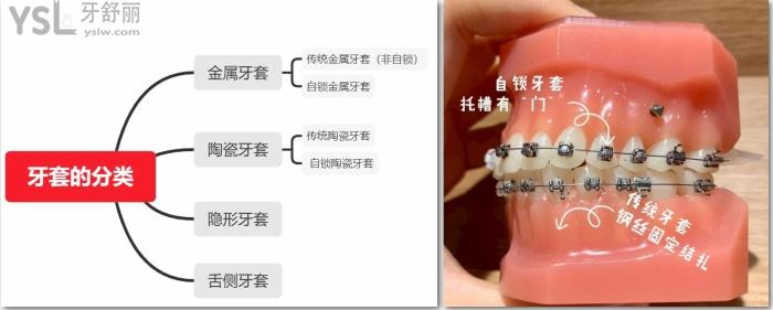 金屬自鎖和陶瓷自鎖哪個(gè)好，有哪些牌子求推薦！.jpg