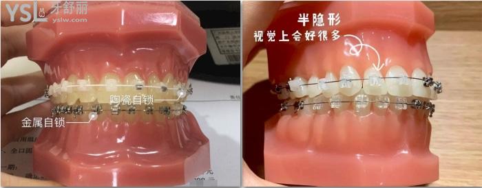 金屬自鎖和陶瓷自鎖哪個(gè)好，有哪些牌子求推薦！.jpg