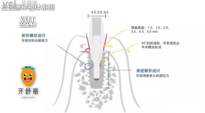 韓國仕諾康和奧齒泰哪個好？看完對比再做種植牙也不遲！.jpg