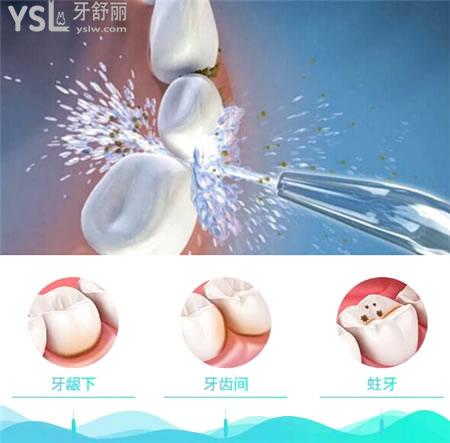 家用沖牙器真的是百利無(wú)一害嗎 好處和壞處有哪些 .jpg