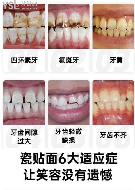 瓷貼面6大適應(yīng)癥