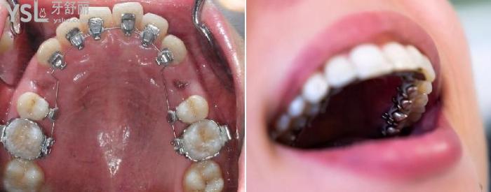 為什么很少人舌側(cè)矯正？是不好用嗎？