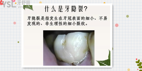 隱裂牙的主要癥狀有哪些 我們又該如何預防牙隱裂呢.png