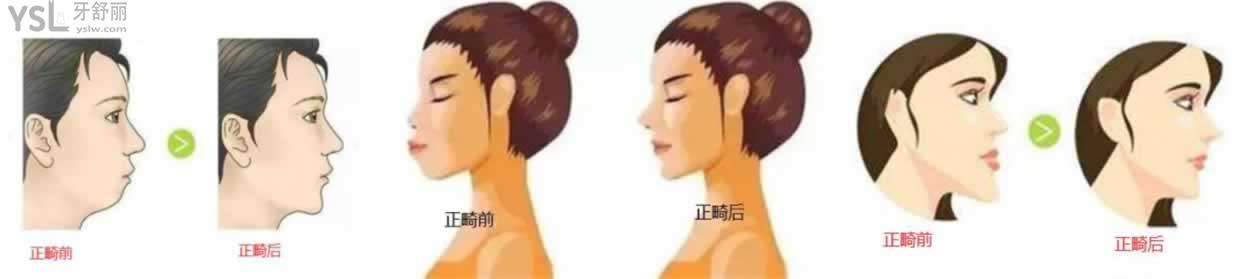 嘴突矯正前后對比圖
