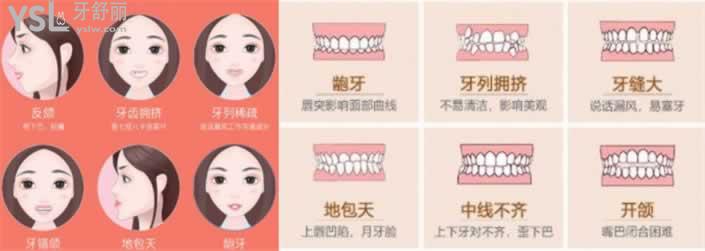 嘴突矯正前后對比圖