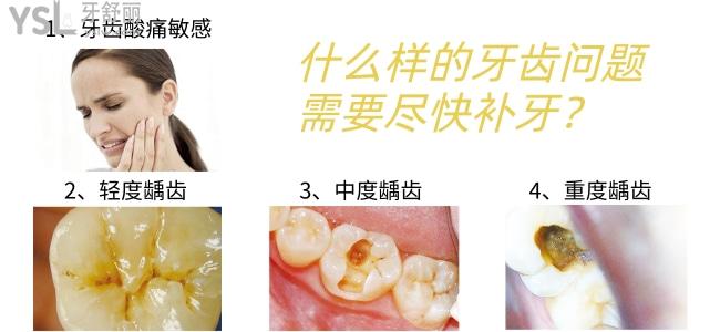什么樣的牙齒問題需要補牙