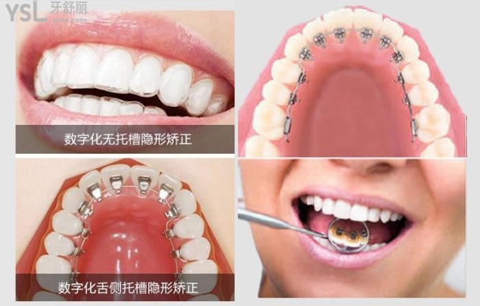 明星們喜歡用的舌側(cè)矯正器很貴嗎？大概多少錢呢？