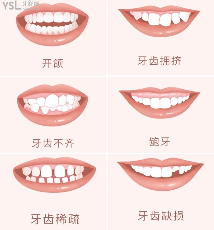 正畸適用牙列癥狀.jpg